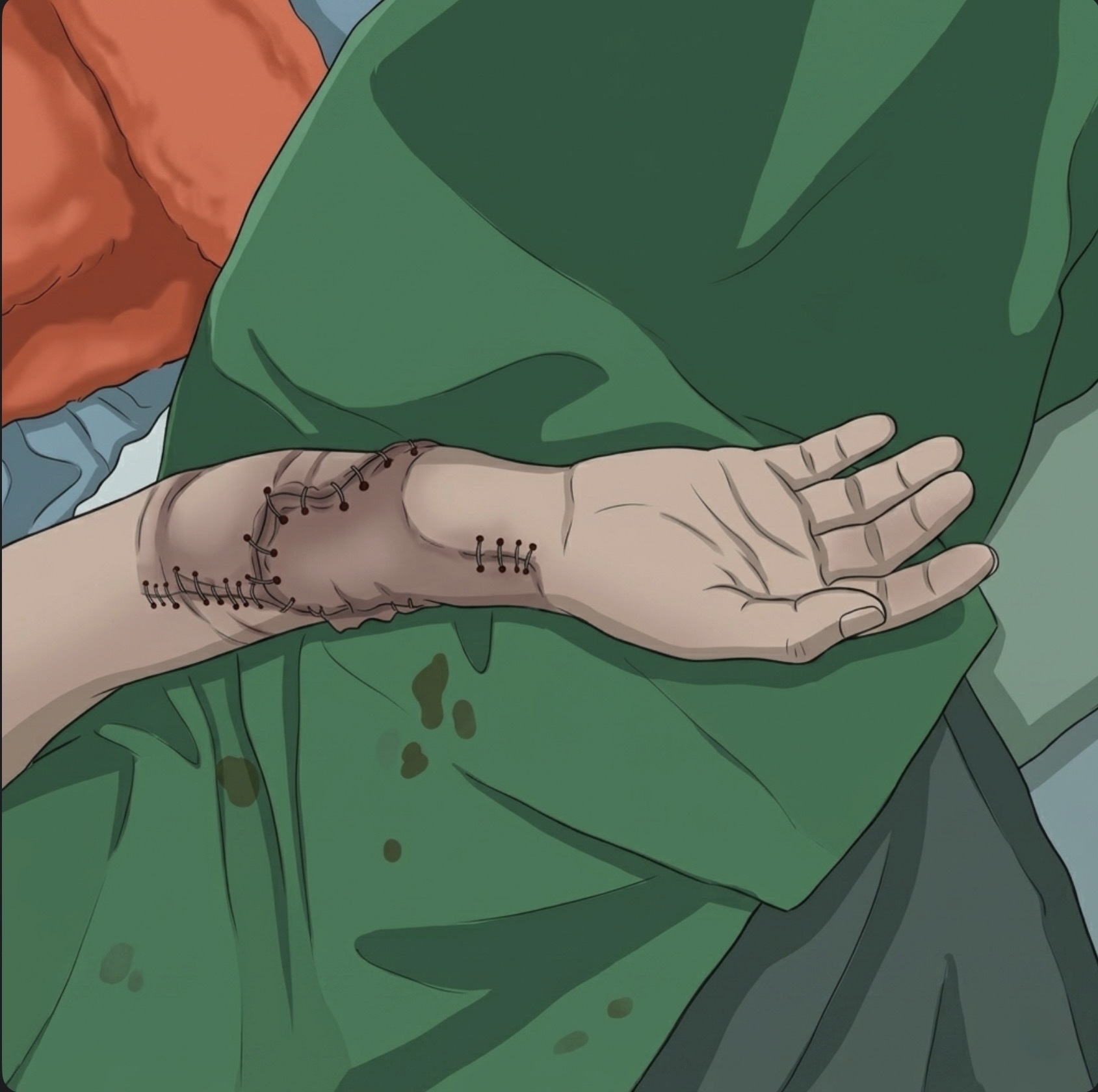 After - Complete Amputation